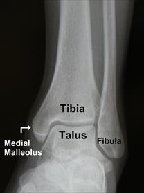 A normal looking ankle X-Ray