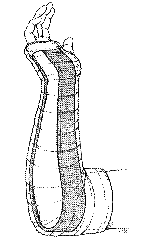 Sugar Tong Splint (Courtesy WikiEM)